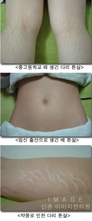 클라랑스 통살 크림 임산부톤살 탄력케어 필수템