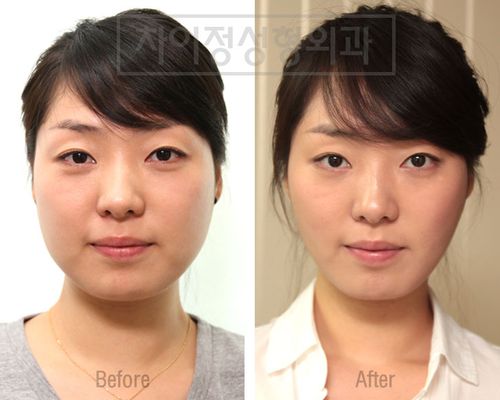 안전한 V라인 시술, 'V턱라인 지방흡입'으로 가능