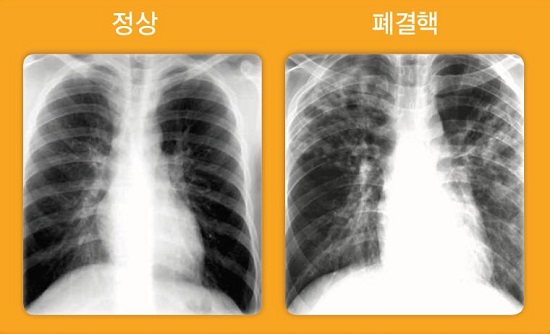 국내 결핵 발생률, OECD 회원국 1위…주요 지표는 감소