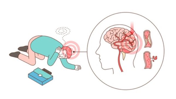코로나19와 환절기에 취약한 뇌졸중 환자
