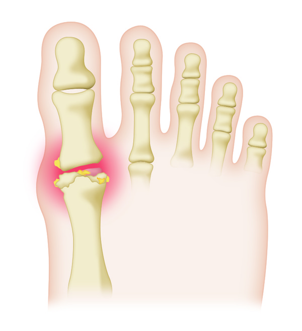 발가락에 발생한 통풍성 관절염.