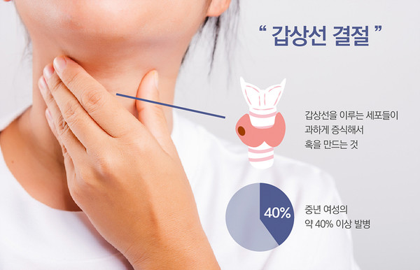 ▲갑상샘 결절 관련 자료