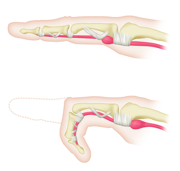 [사진설명] 손가락에 반복적으로 부담이 누적될 경우 손가락 힘줄에 염증이 생겨 방아쇠수지증후군을 일으킬 수 있다.