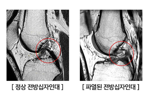 정상과 파열된 전방십자인대 비교