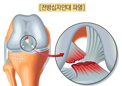전방십자인대파열