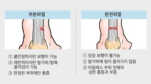 파열의종류