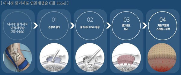 내시경 줄기세포 연골재생술