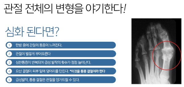 통풍성관절염-심화