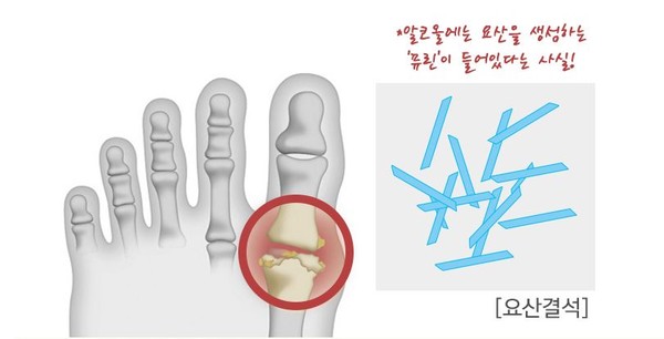 통풍성관절염-요산