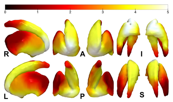 도파민 수송체 섭취율 감소의 선조체 분포.