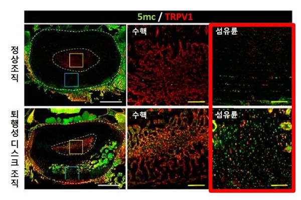[사진설명] 디스크 조직 분석 결과 퇴행성 허리디스크 모델의 섬유륜 부위에서 5mC와 TRPV1 발현이 두드러지게 나타났다.