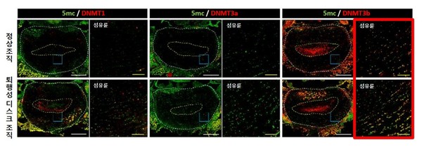 [사진설명] 퇴행이 진행된 디스크의 DNA 메틸화에 DNMT3b 효소가 가장 크게 관여하는 것으로 밝혀졌다.