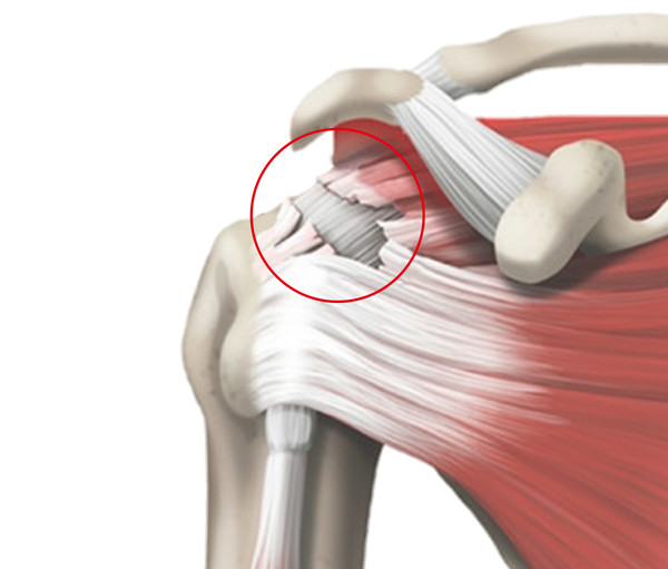 회전근개파열-이미지