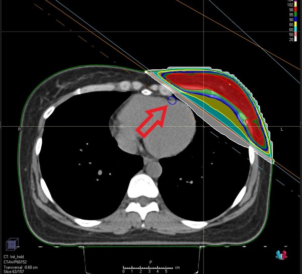 브레스홀딩 방사선치료 시 설계화면.