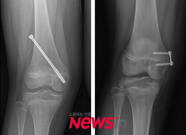 외반슬(엑스자 다리)에 대한 성장판 부분 유합술 시 이용되는 나사못(좌측)과 금속판(우측)
