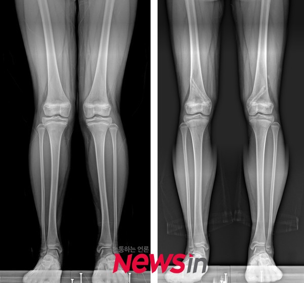 허벅지뼈에서 시행한 성장판 부분 유합술 후 외반슬(엑스자 다리)이 교정된 환자 (좌-수술 전, 우-금속 제거 후)