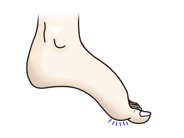 족부 첨족 변형.