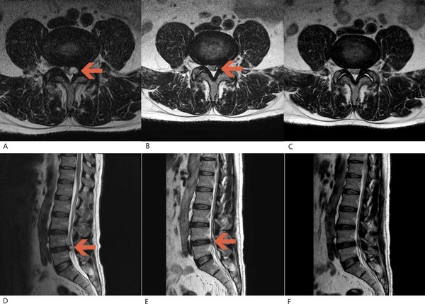 [사진설명] 한의통합치료를 통한 요추후관절낭종 환자의 치료 경과