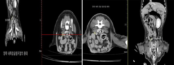 △ 반려견 대상 폴리탁셀 4.5mg/kg 항암효능시험 결과, 림프절 전이암 크기. (제공= 현대바이오)(좌)투약 전 림프절 전이암 크기(가로 10.06mm-세로 6.63mm-높이 19.35mm),(우)투약 후 림프절 전이암 크기(가로 5.91mm-세로 3.98mm-높이 14.26mm).