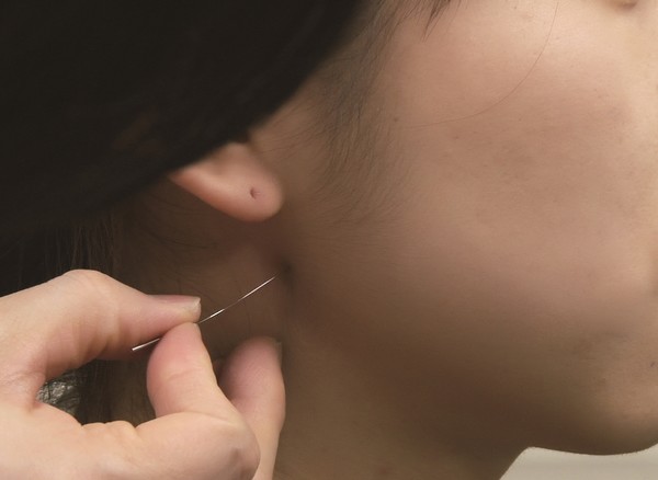 [사진 설명]턱관절 장애 치료를 위해 약침을 놓고 있다.