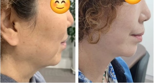 안면거상술'전후사진