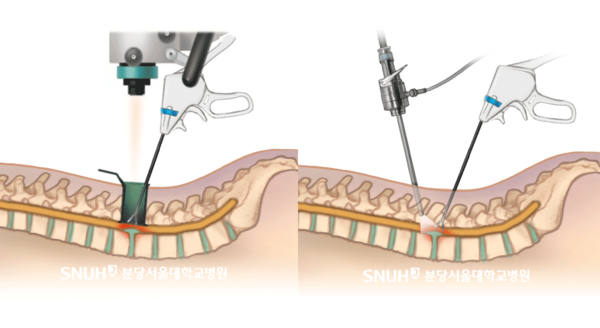 현미경 디스크 절제술(좌)과 양방향 내시경 디스크 절제술(우)의 모식도. 