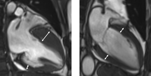 왼쪽부터 비후성 심근병증을 가진 환자의 자기공명영상, 정상 심장 자기공명영상.